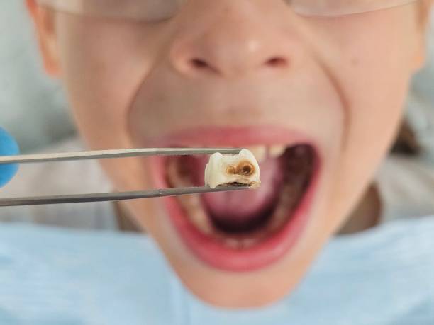 Best Emergency Root Canal Treatment in Central, SC