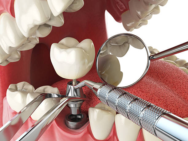 Best Emergency Dentist for Lost Fillings or Crowns in Central, SC