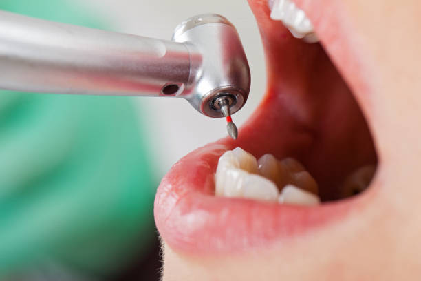 Best Broken or Cracked Tooth Emergency Dentist in Central, SC